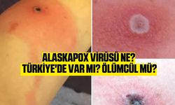 Alaskapox virüsü ne? Türkiye'de var mı? Ölümcül mü?