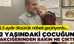 Öksürük nöbetleri geçiren 2 yaşındaki çocuğun akciğerinden öyle bir şey çıktı ki