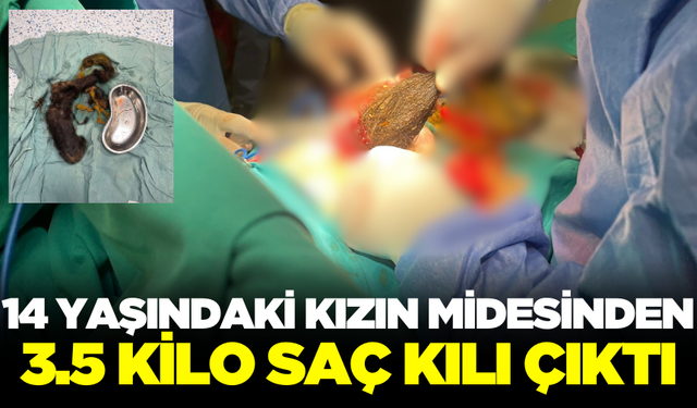 14 yaşındaki kızın midesinden 3.5 kilo saç kılı çıktı