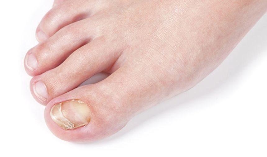 Tırnak Mantarı Belirtileri Tırnak Sağlığınızı Tehlikeye Atmayın