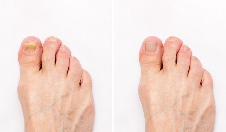 Tırnak Mantarı Nedenleri, Belirtileri ve Tedavisi